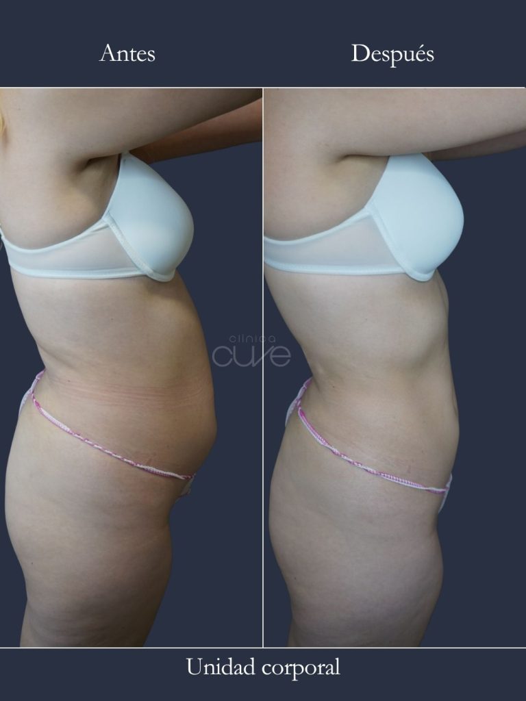Antes y después grasa localizada eliminada en clinica cuve
