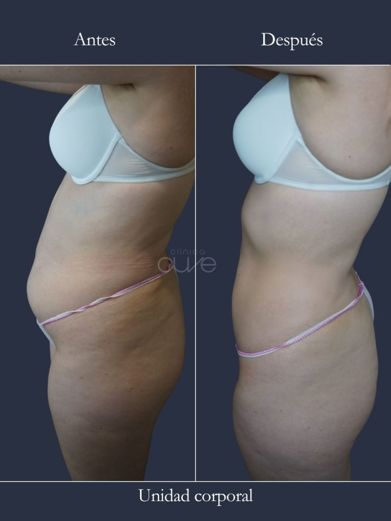Antes y después grasa localizada eliminada en clinica cuve