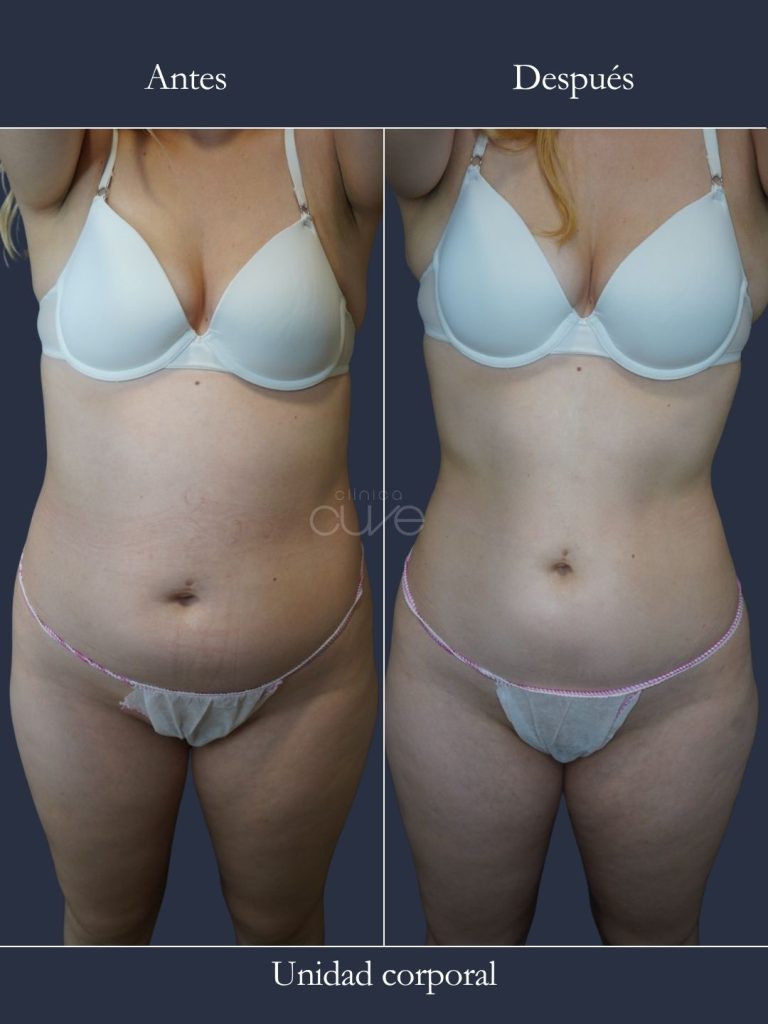 Antes y después grasa localizada eliminada en clinica cuve
