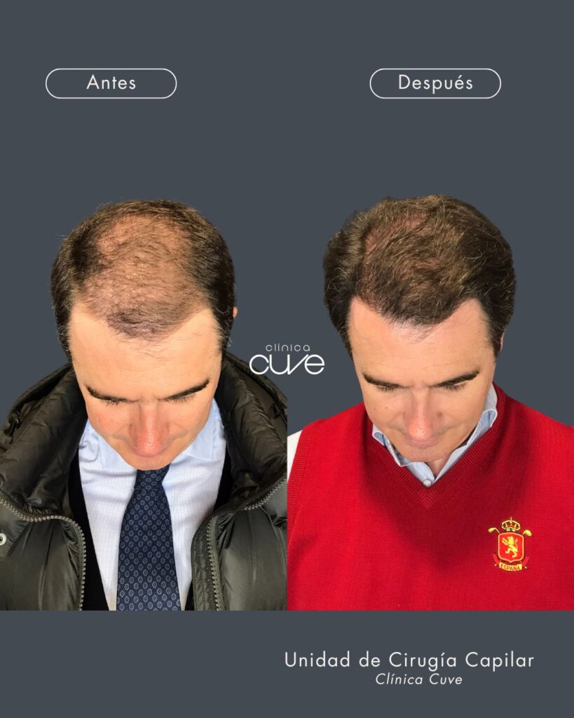 Clinica-de-Trasplante-Capilar-819x1024