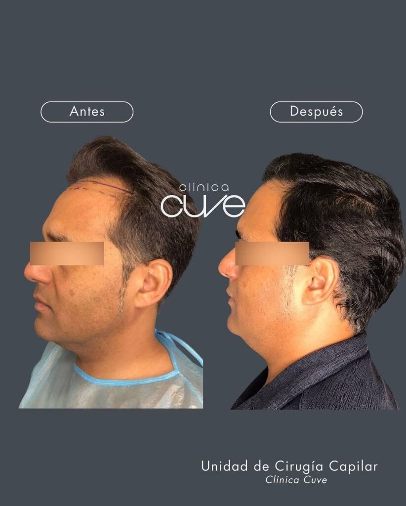 Injerto-Capilar-Cuve-en-Sevilla-2-822x1024