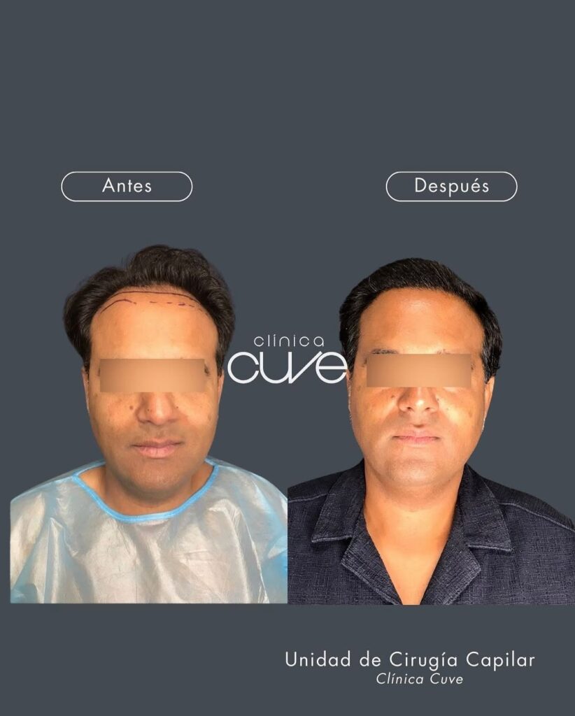 Injerto-Capilar-Cuve-en-Sevilla-3-822x1024
