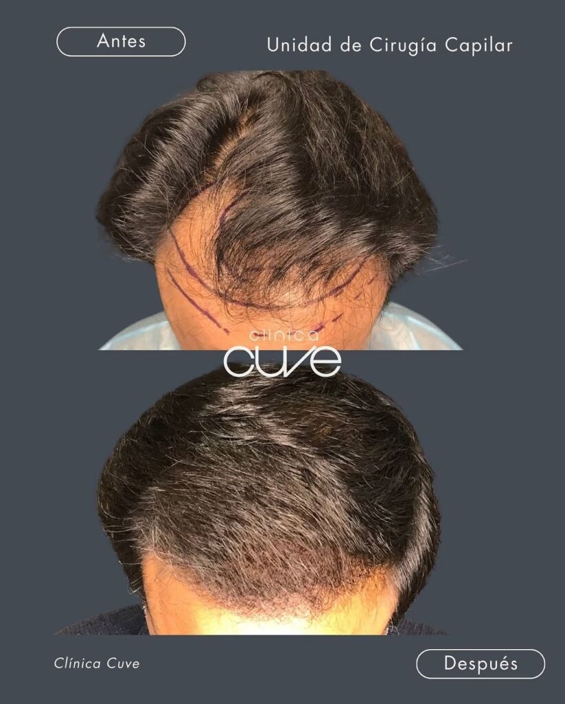 Injerto-Capilar-Cuve-en-Sevilla-822x1024 (1)