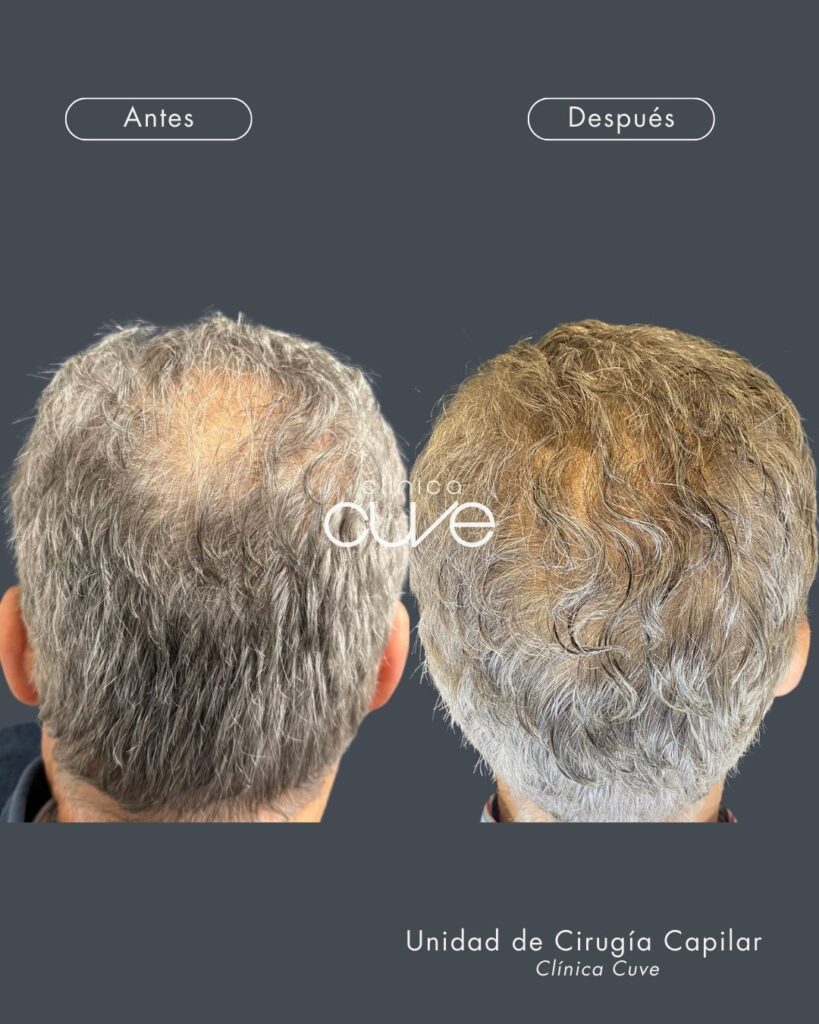 Injerto-Capilar-en-Sevilla-819x1024