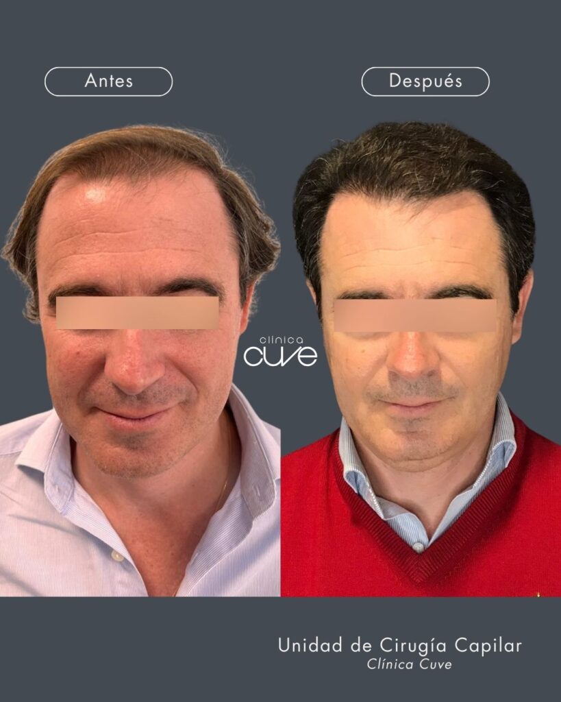 Trasplante-Capilar-819x1024