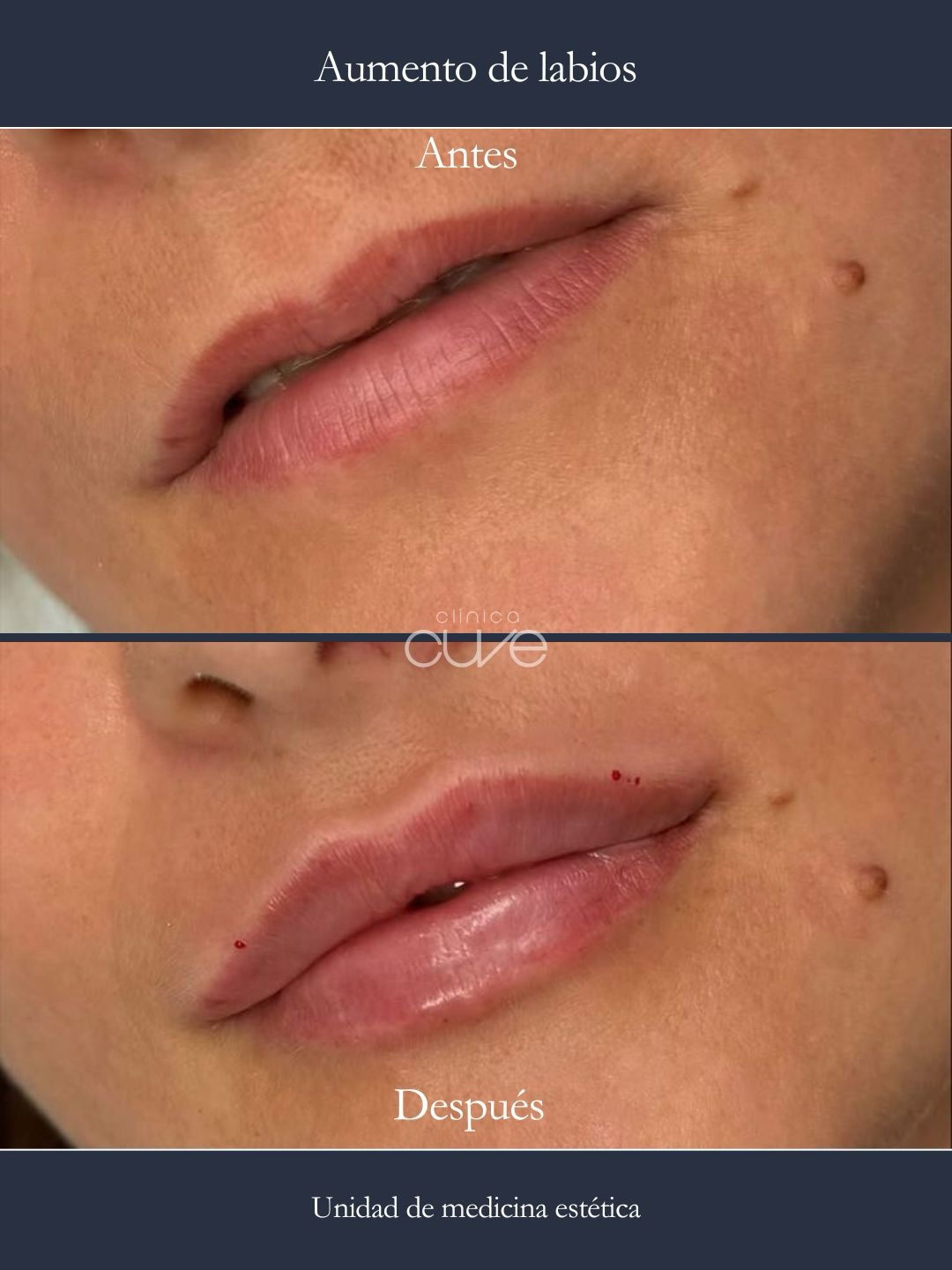 Aumento labios Clinica Cuve Sevilla (1)