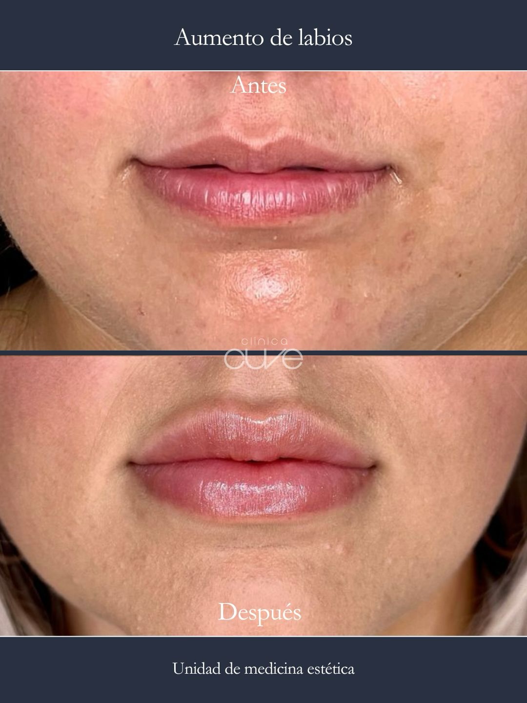 Aumento labios Clinica Cuve Sevilla Zona Nervion