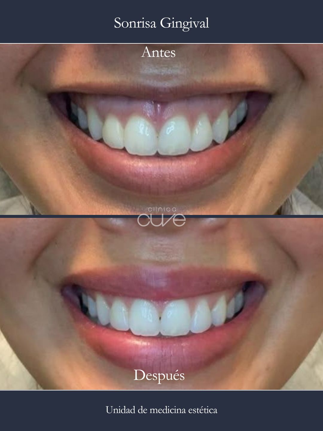 Sonrisa Gingival Clinica Cuve Sevilla Nervion