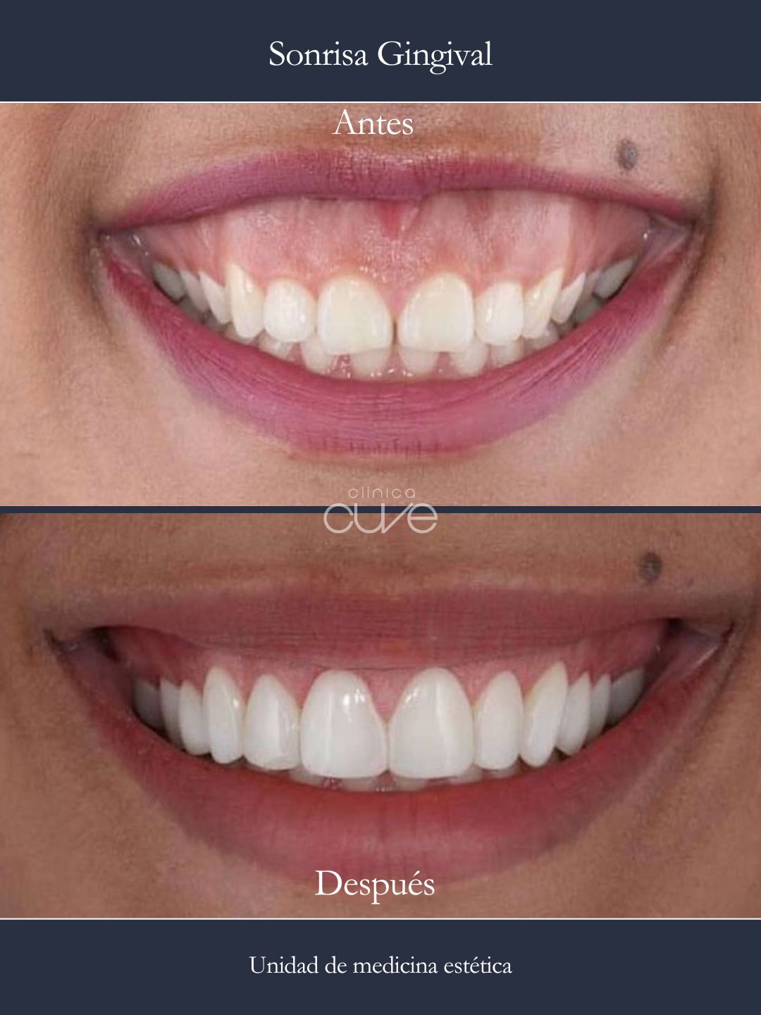 Sonrisa Gingival Clinica Cuve Sevilla