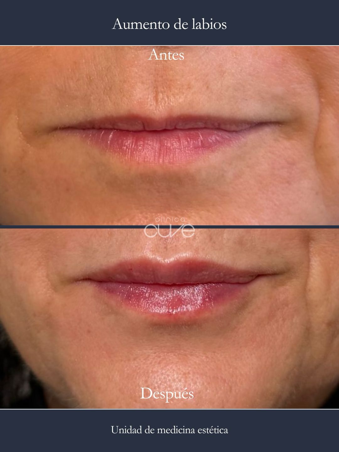 Volumen en labios Clinica Cuve Sevilla Nervion